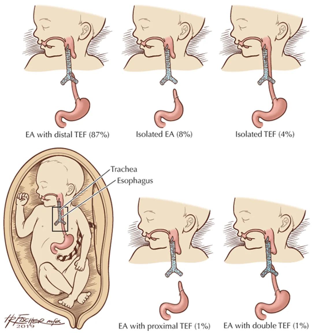 Diagram of EA/TEF in fetus
